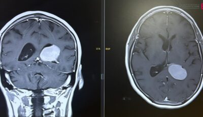 مستشفى الدكتور سليمان الحبيب بالخبر ينهي معاناة “سبعينية” مع ورم دماغي متزايد